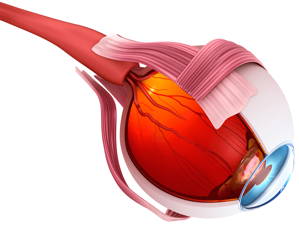 Retinal Detachment - Vitreo-Retinal Consultants