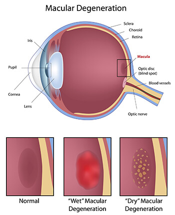 Medical Illustration of Macular Degeneration