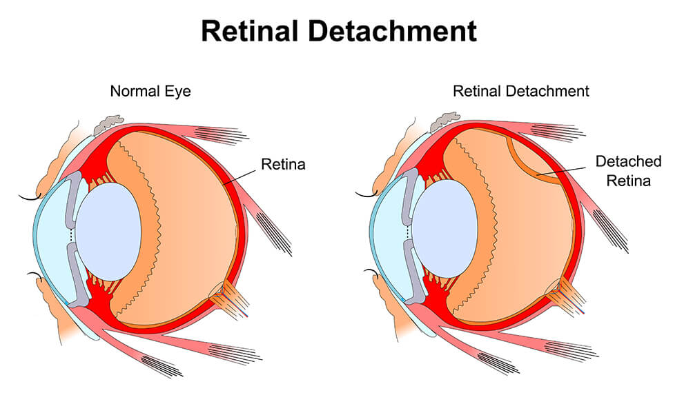 Medical Illustration of a Detached Retina